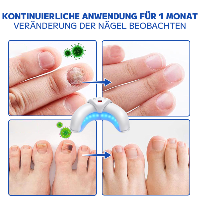 FURZERO™ ЛАЗЕРЕН АПАРАТ ЗА ЛЕЧЕНИЕ НА ГЪБИЧКИ ПО НОКТИ