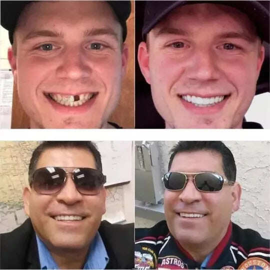 O mais recente snap-on ajustáveldentadura