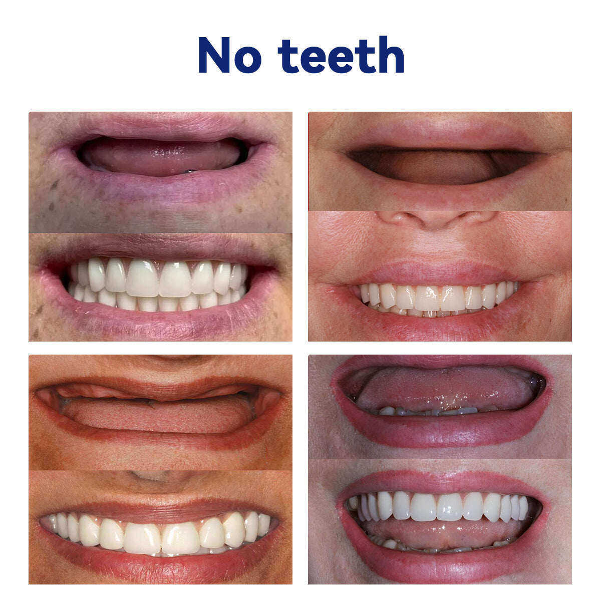 ✅Loja oficial | Conjunto de próteses de silicone Bikenda™ Reline 🧑🏼‍⚕️Recomendação da British Dental Association (BDA)