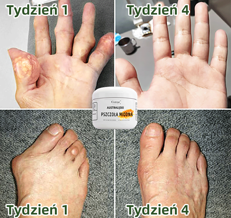 🚩🚩 Creme Australian Honey Bee Truison Cvreoz ™ para controle da dor e cura óssea (🐝 Desconto por tempo limitado nos últimos 30 minutos 💥）