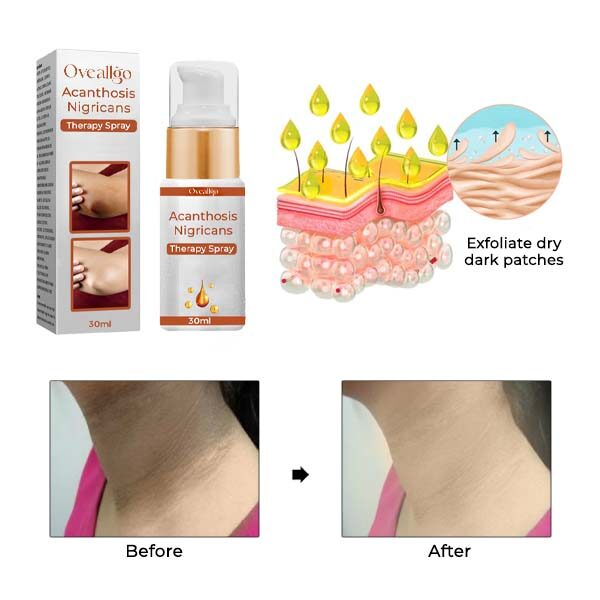 Spray de terapia Oveallgo™ Acantose Nigricans