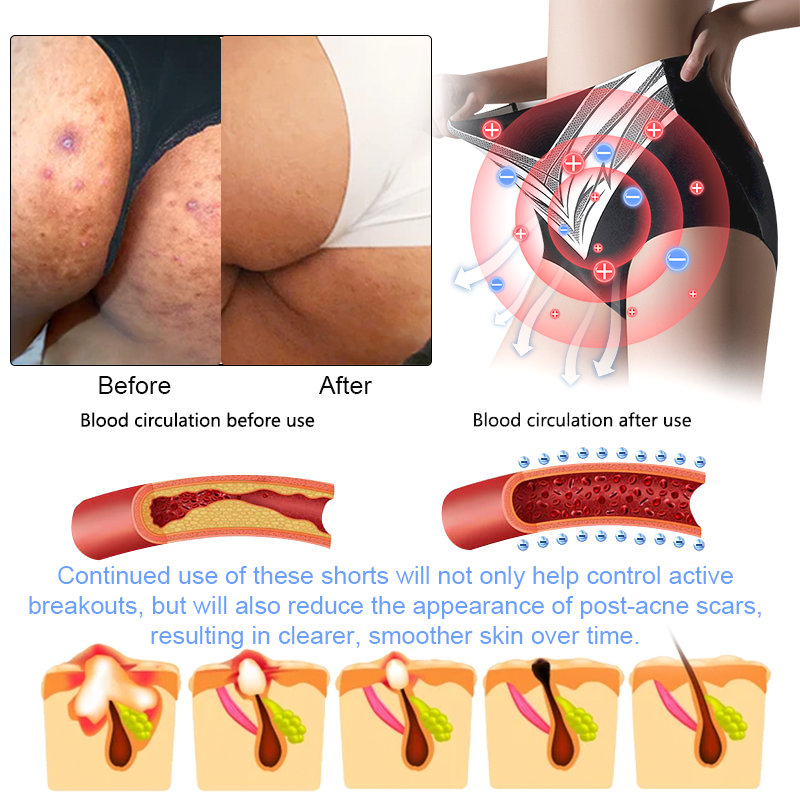 🎉 Предложение за ограничено време - Голяма отстъпка! 🔥 До 90% ОТСТЪПКА! 💰 Къси панталони с турмалиново оформящо облекло Sfrcord™ от титанови влакна✅✅