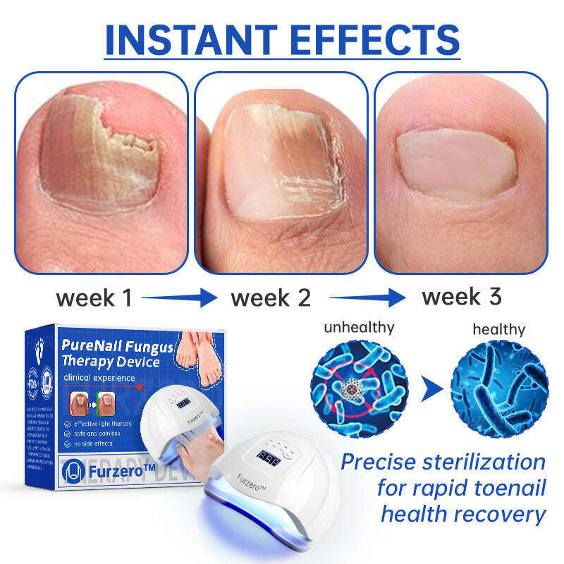 Dispositivo de tratamento laser Furzero™ PureNail para fungos