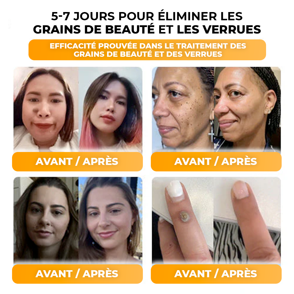 Creme anti-verrugas e verrugas com veneno de abelha