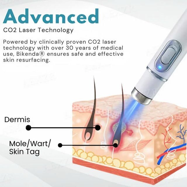 [⚡️NAJLEPSZA OFERTA DZIŚ]🔥Nieinwazyjny laser do usuwania znamion i brodawek