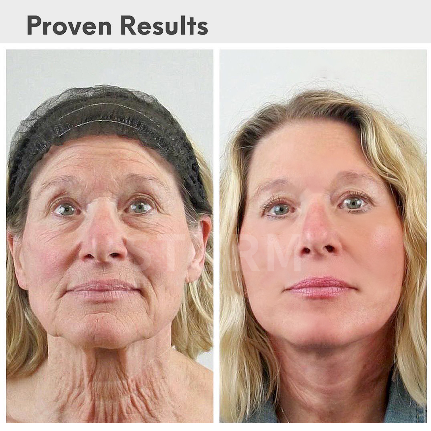 STURM® LUXURY ANTI-AGING SERUM COM ÁCIDO HIALURÔNICO 🔥 (PROMOÇÃO POR TEMPO LIMITADO ÚLTIMAS 660 MINUTOS)