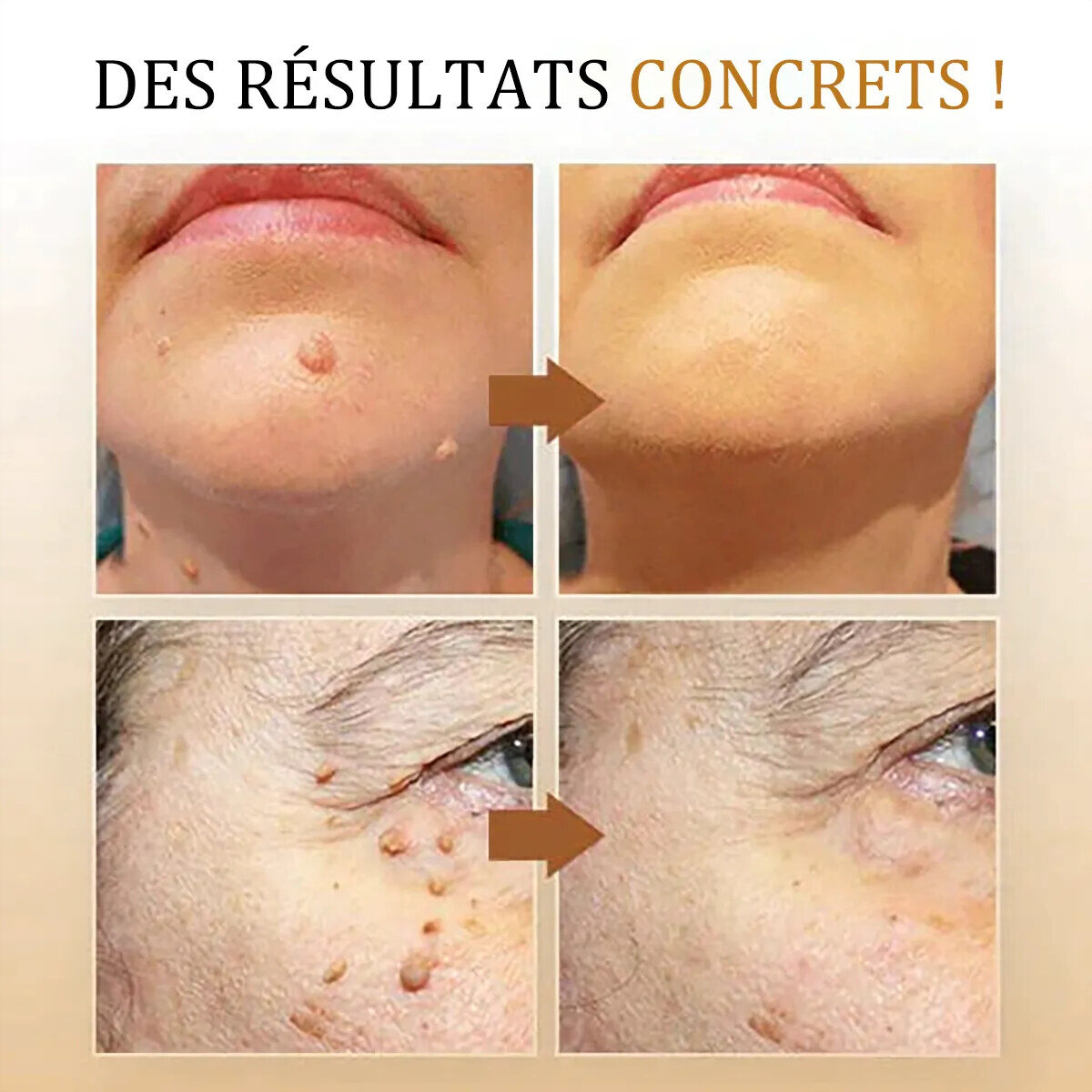 🧡 Spray Cvreoz com veneno de abelha para remover verrugas e manchas (👨‍⚕DAA RECOMENDA)🐝🐝(🔥Oferta de último dia com 50% de desconto