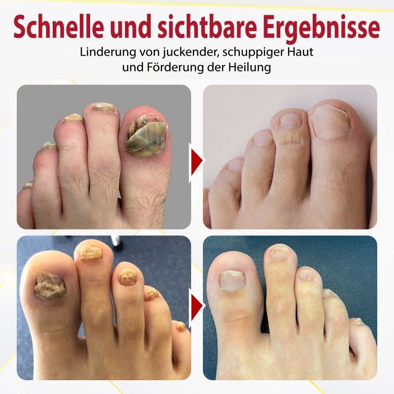 Japão NailRenew™ óleo de onicomicose rápida | 1+1 GRÁTIS