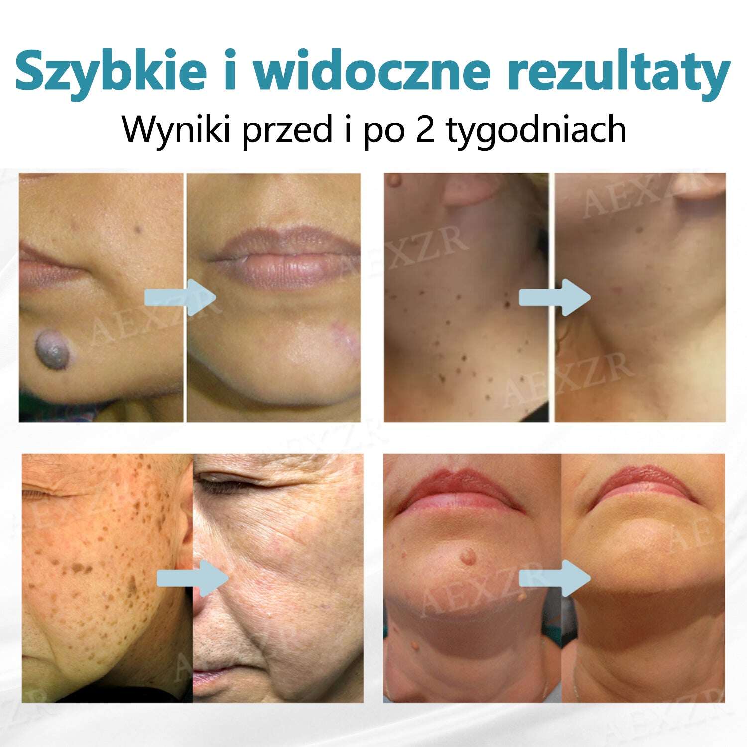 Cvreoz® új, nem invazív lézer anyajegyek és szemölcsök eltávolítására ✅