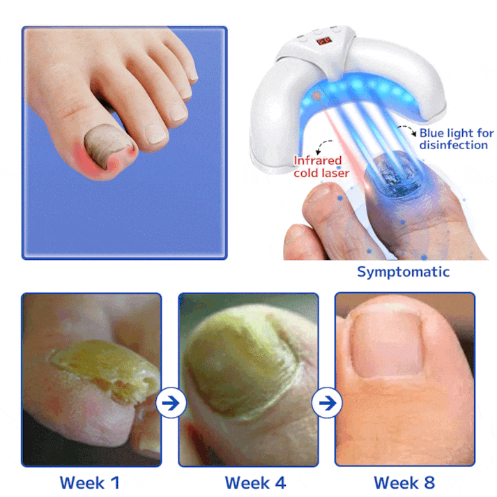 Dispositivo de tratamento de unhas a laser Furzero™