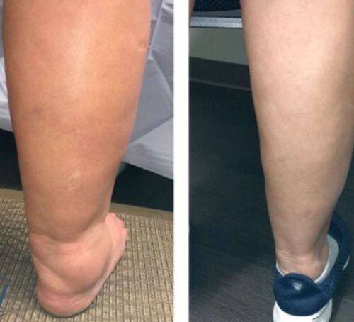 Meias medicinais AFIZ para emagrecimento dos gânglios linfáticos da turmalina