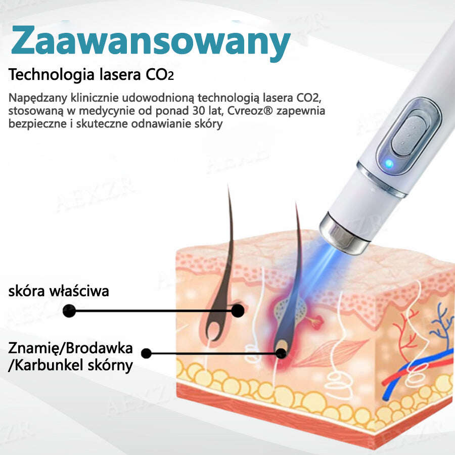 Cvreoz® új, nem invazív lézer anyajegyek és szemölcsök eltávolítására ✅
