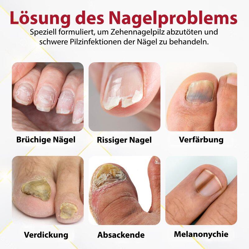 Japão NailRenew™ óleo de onicomicose rápida | 1+1 GRÁTIS