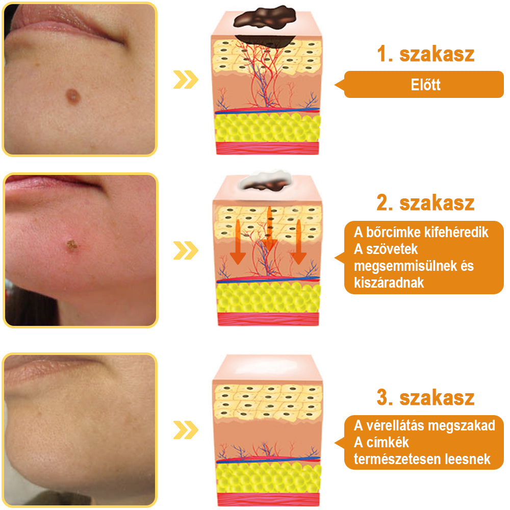 【💗utánvétel (COD)💗】Méhméreg szemölcs és övsömör eltávolító spray (👨‍⚕AAD Ajánlott) 🐝🐝🔥(🔥Last Day 80% Off)