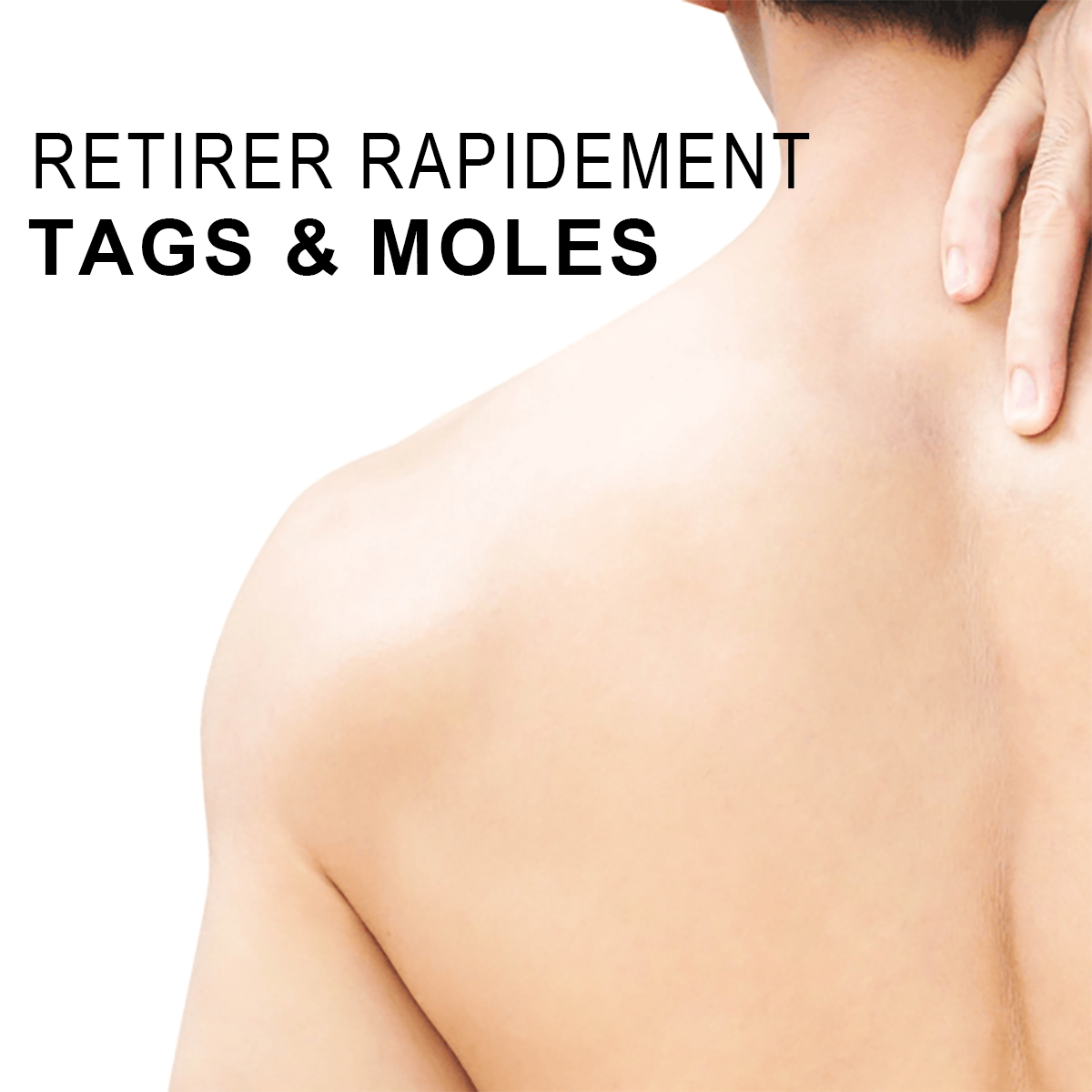 🧡 Spray de tratamento Cvreoz Bee Venom para remover verrugas e marcas (👨‍⚕DAA RECOMENDADO)🐝🐝(🔥Oferta do último dia com 80% de desconto