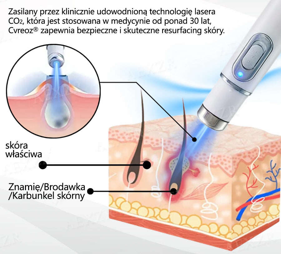 Cvreoz® új, nem invazív lézer anyajegyek és szemölcsök eltávolítására ✅