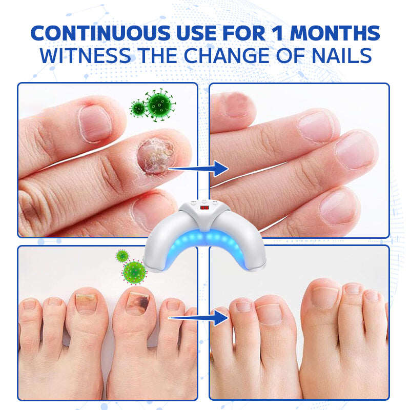 Furzero™ Dispositivo laser para o tratamento de unhas fúngicas