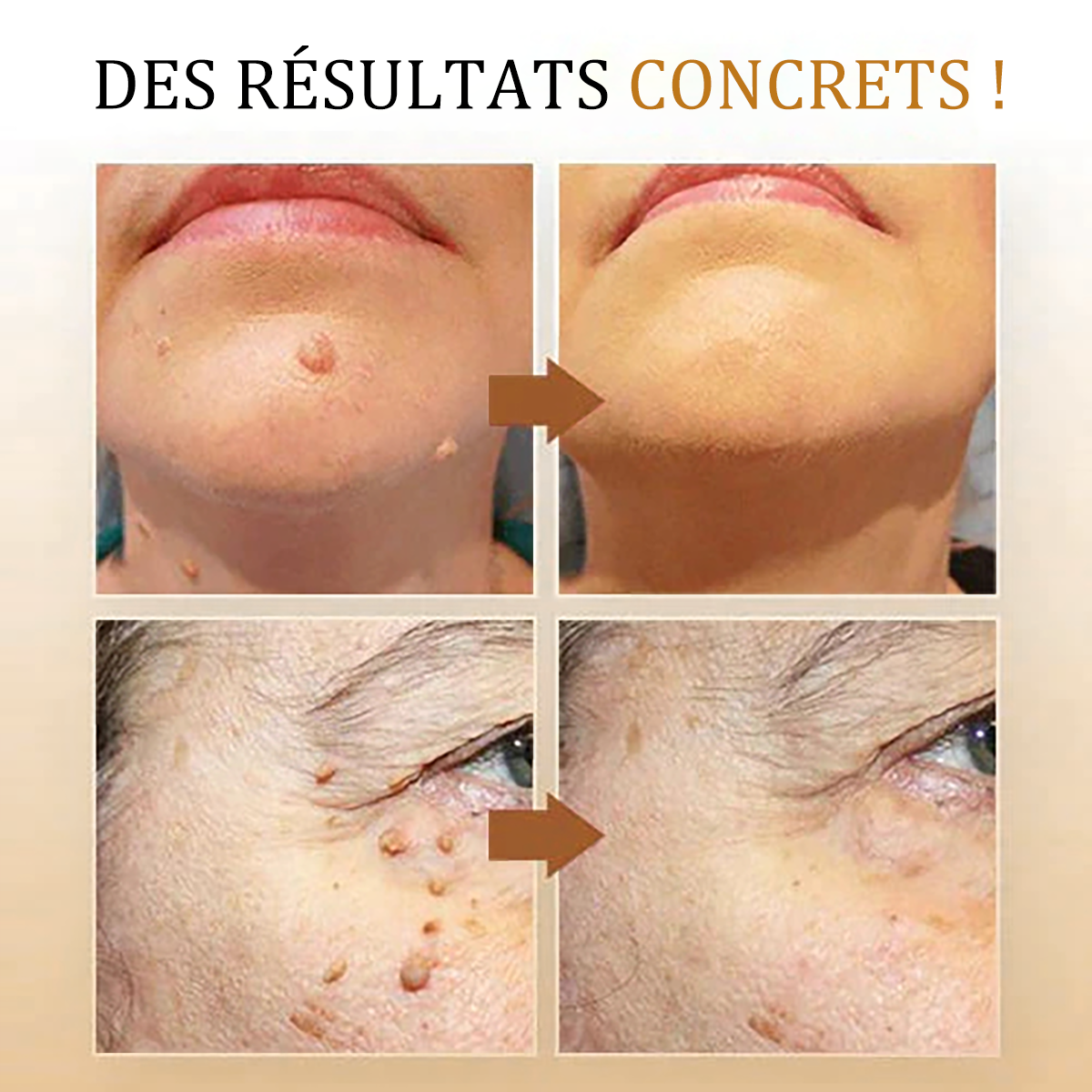 🧡 Spray de tratamento Cvreoz Bee Venom para remover verrugas e marcas (👨‍⚕DAA RECOMENDADO)🐝🐝(🔥Oferta do último dia com 80% de desconto