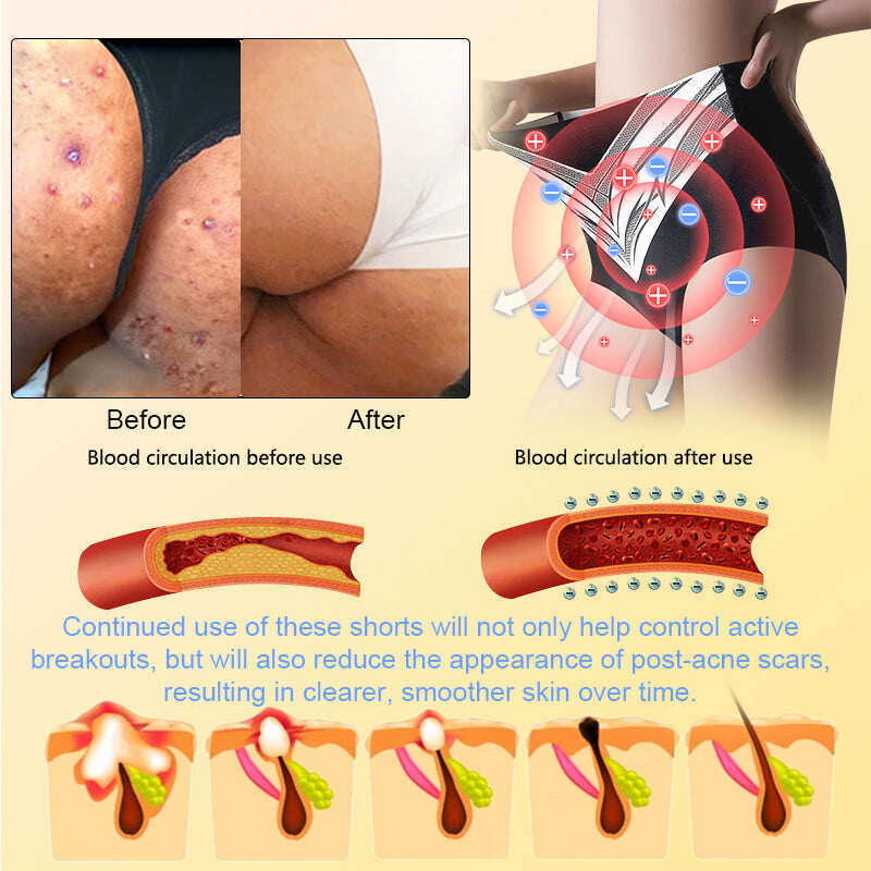 【ILF R&D】PaURAJU™ Магнитни турмалинови оформящи шорти ❤️ Голяма новогодишна разпродажба 40%