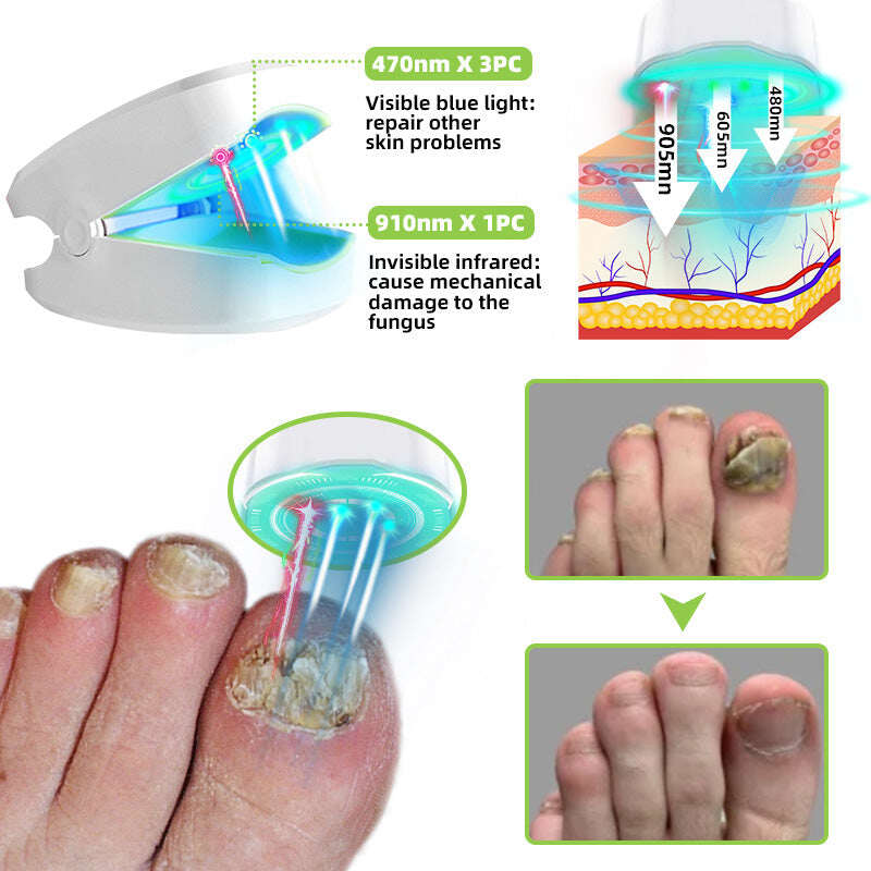 Laserové zariadenie na liečbu plesní nechtov Furzero™ Max Plus