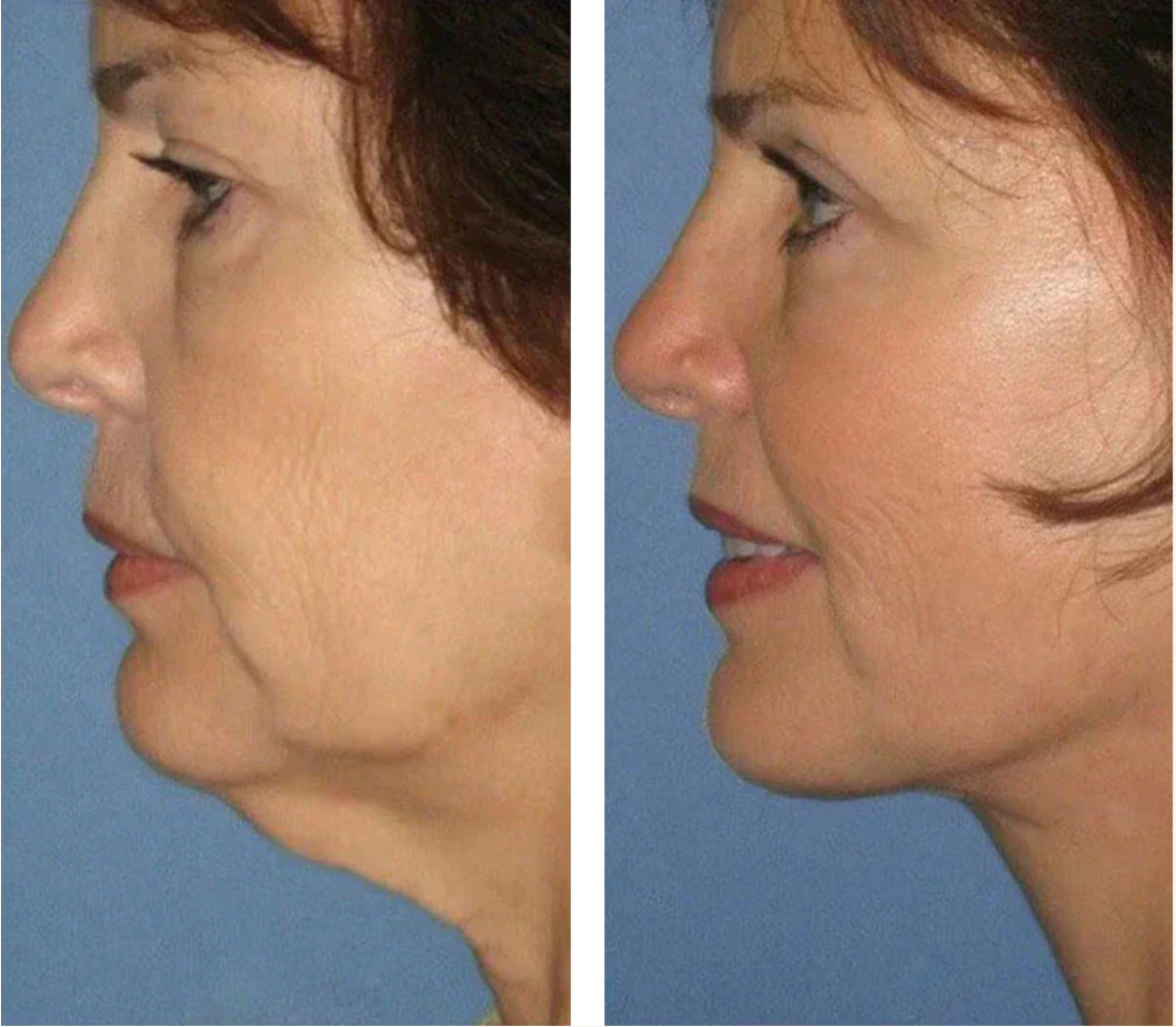 Sleepiz® | Dispositivo 3 em 1 para eliminar rugas, gordura no pescoço e firmar a pele