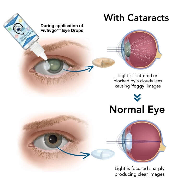 Капки за очи Fivfivgo™ против късогледство