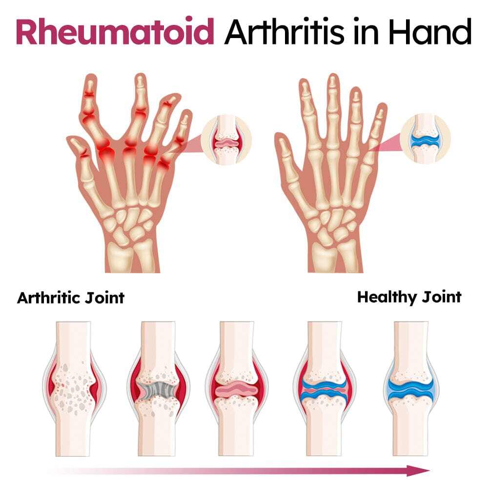 GFOUK™ Perfectx Creme de Recuperação de Articulações e Ossos