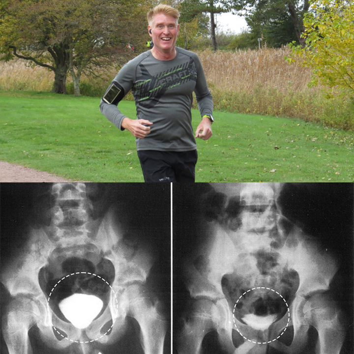 Йонна лента за терапия Oveallgo™ ProstaPulse