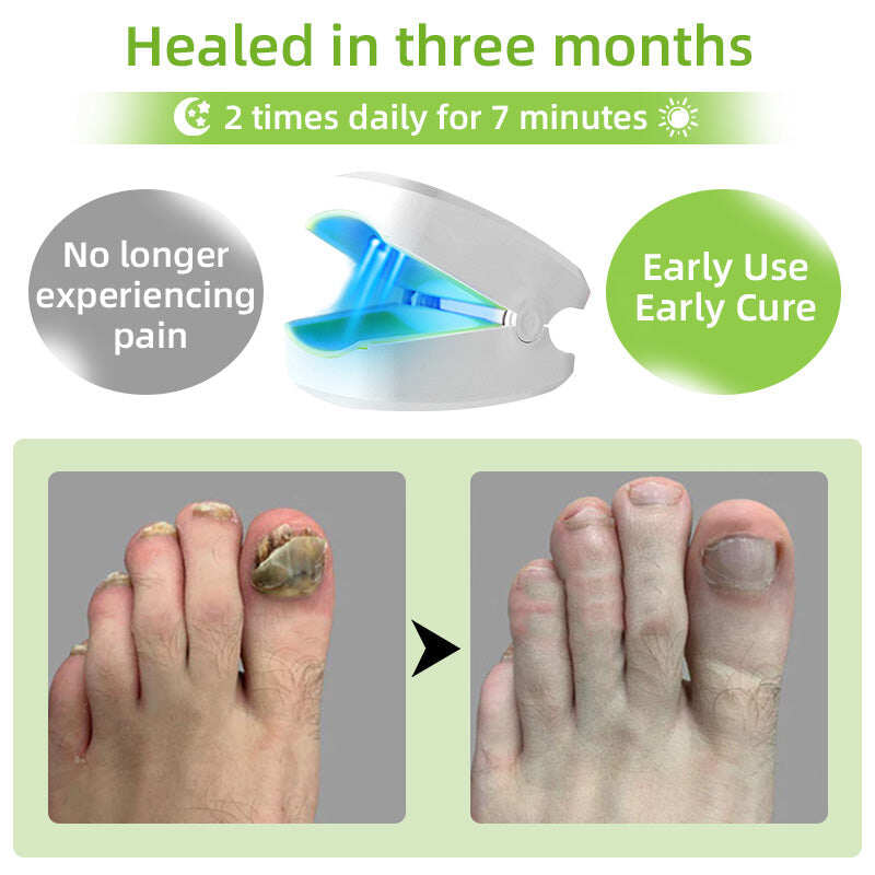 Dispositivo de terapia a laser para fungos nas unhas Furzero™ Max Plus