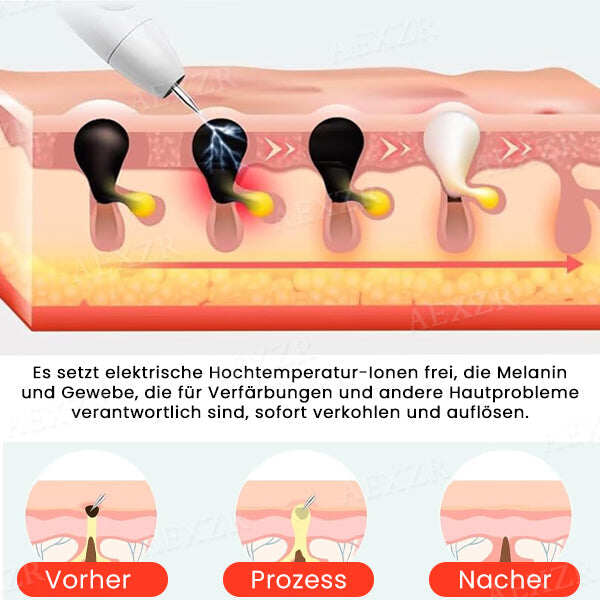 Fivfivgo™ Caneta laser portátil para cuidados da pele