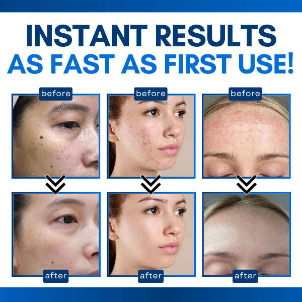 ELECTRODERM™ ПИСАЛКА ЗА ТРЕТИРАНЕ НА КОЖНИ МАРКЕРИ