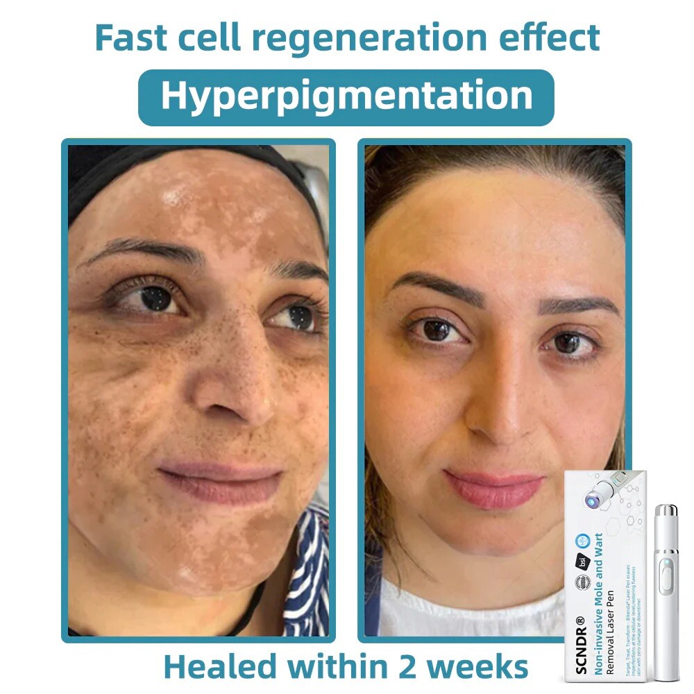 Caneta a laser para remoção de pintas e verrugas não invasiva SCNDR® 🏅