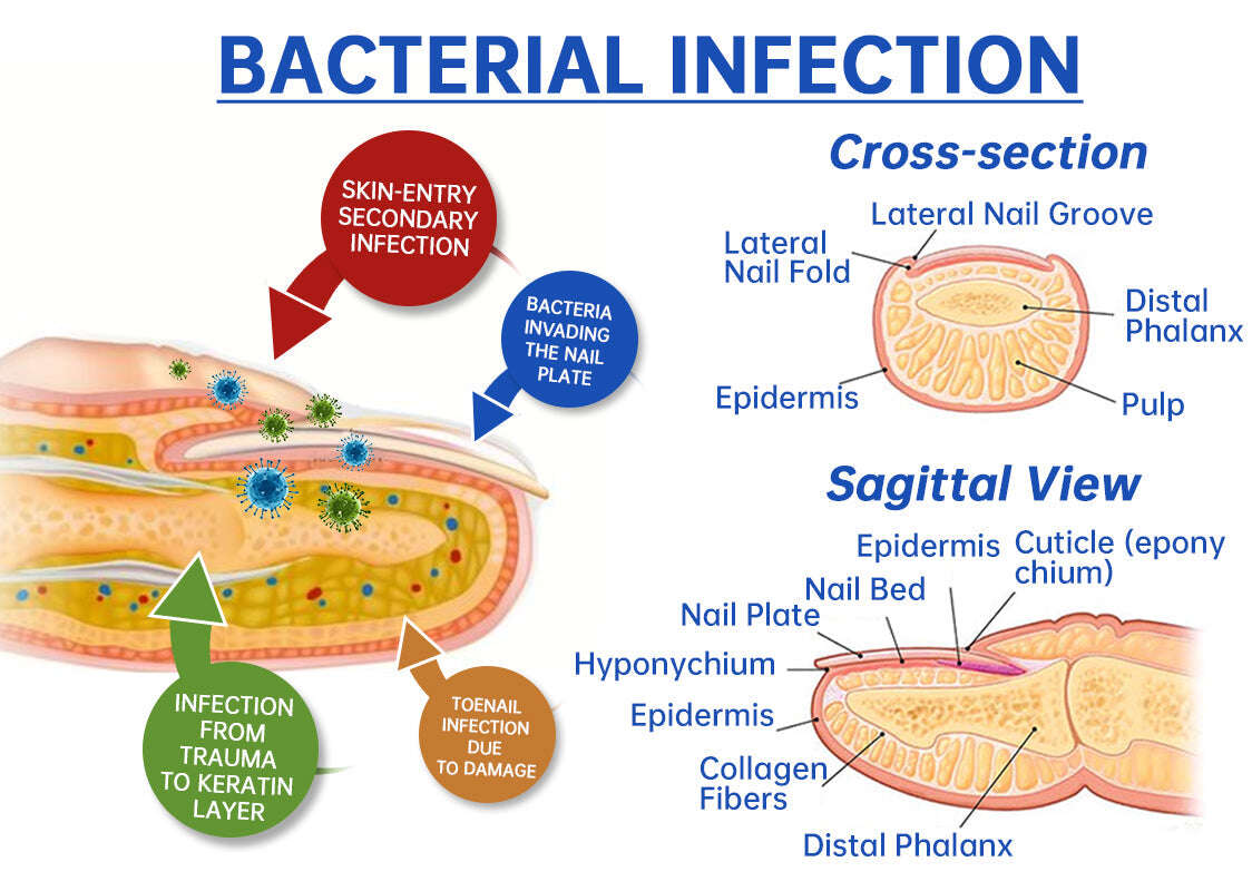 🎅Ειδικές χριστουγεννιάτικες εκπτώσεις: 62% ΕΚΠΤΩΣΗ🎄QIAWI™ PureNail Fungus Laser Device-🗽Παραγωγή και αποστολή από ΗΠΑ👏