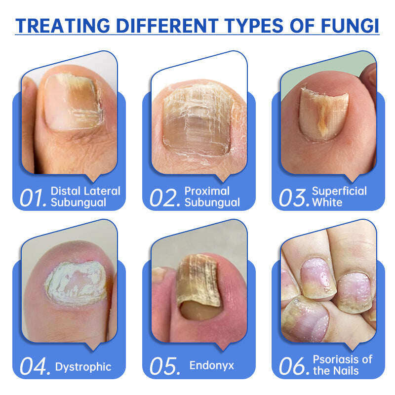 🎅Descontos especiais de Natal: 62% OFF🎄QIAWI™ PureNail Fungus Laser Device - 🗽Fabricado e enviado dos EUA👏