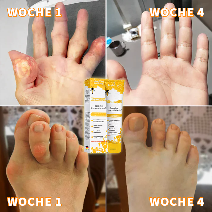 🐝🐝Aeehfeng™ Bee Venom Joint Therapy Pain Relief Gel (Extrato de Abelha da Nova Zelândia - Especializado em dores ortopédicas e de artrite)