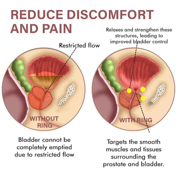 Пръстен за облекчаване на простатата Oveallgo™ MagnaCopper