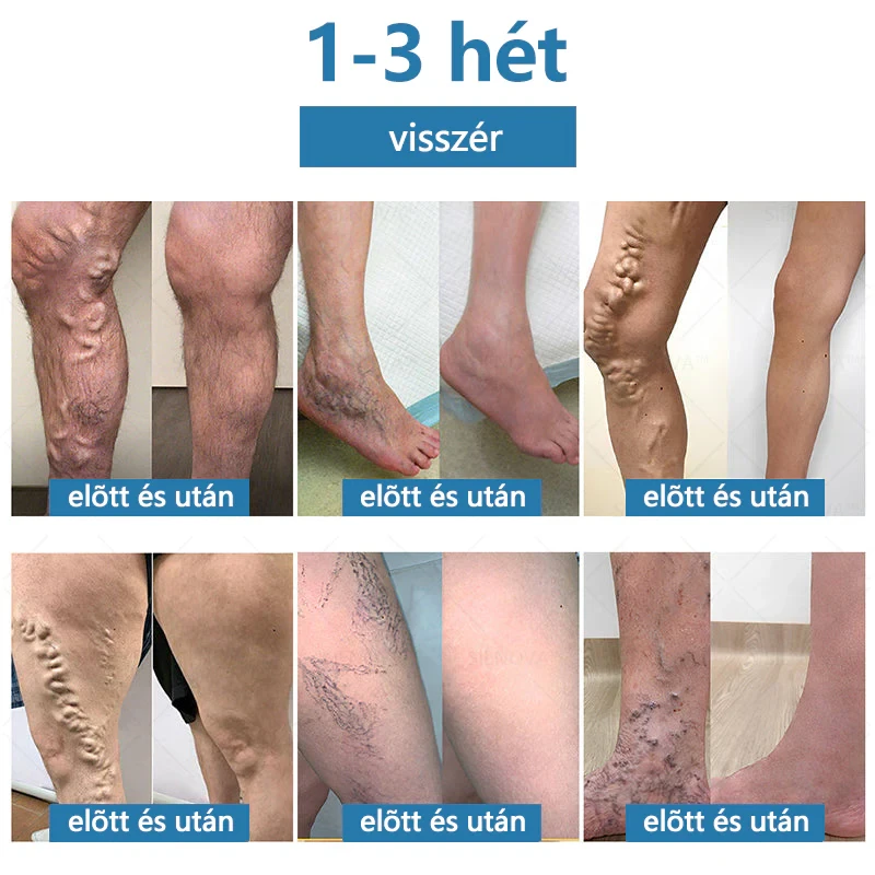 SIENOVATM💎 Dispositivo portátil para drenagem linfática e relaxamento articular👨‍⚕️ Terapia 2 em 1 original