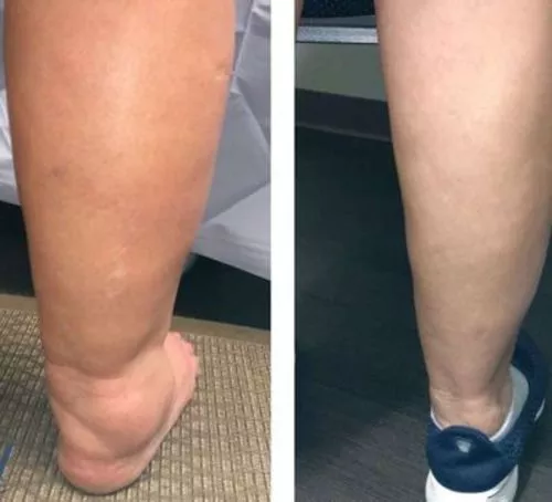 Meias medicinais AFIZ para emagrecimento dos gânglios linfáticos da turmalina