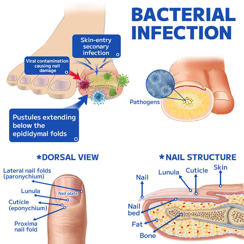 Dispositivo de tratamento de unhas a laser Furzero™