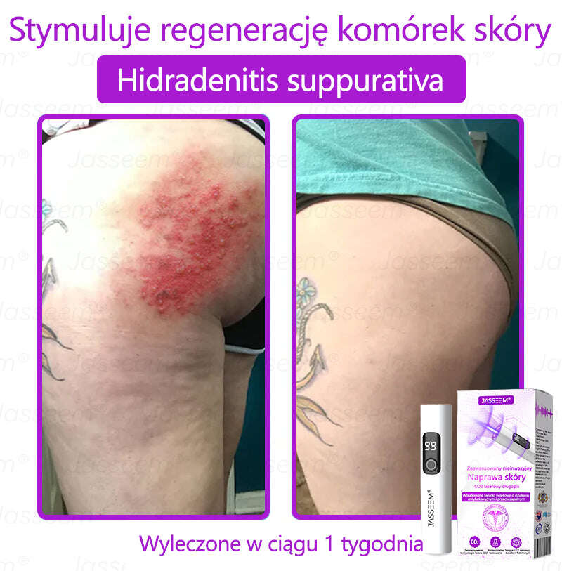 𝐉𝐚𝐬𝐬𝐞𝐞𝐦® Усъвършенстван неинвазивен CO₂ лазер за възстановяване на кожата 🎉 (Нежно премахва брадавици, бенки, старчески петна и кожни образувания – без болка, без суетене!)