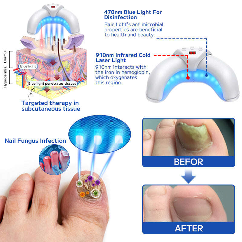 Dispositivo de tratamento de unhas a laser Furzero™
