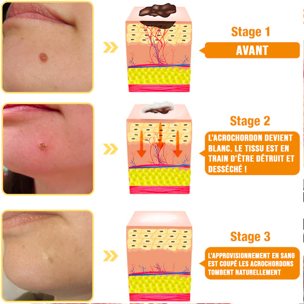 Spray de tratamento com veneno de abelha (para todas as anormalidades da pele)