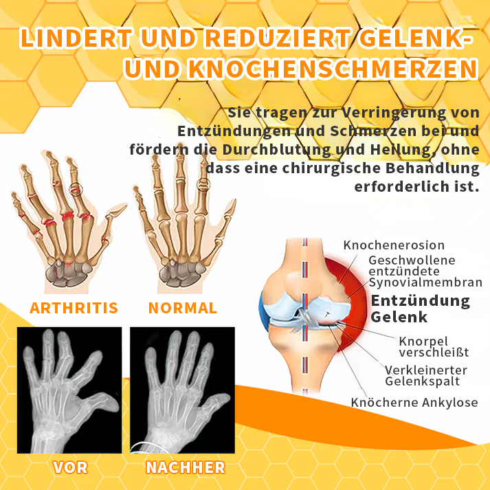 🐝🐝Aeehfeng™ Bee Venom Joint Therapy Pain Relief Gel (Extrato de Abelha da Nova Zelândia - Especializado em dores ortopédicas e de artrite)