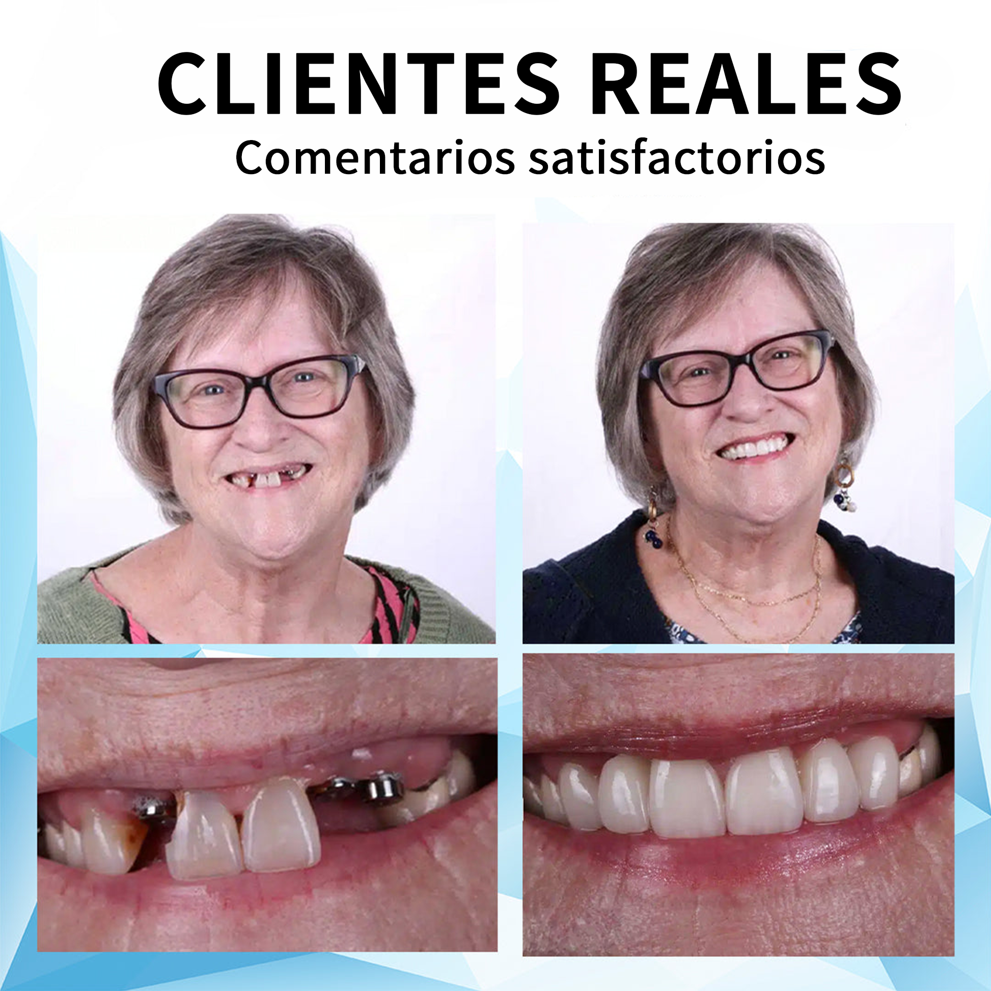 Manga de restauração dentária de silicone Bikenda™️ (⏰Oferta por tempo limitado, últimos 30 minutos⏰)🐳