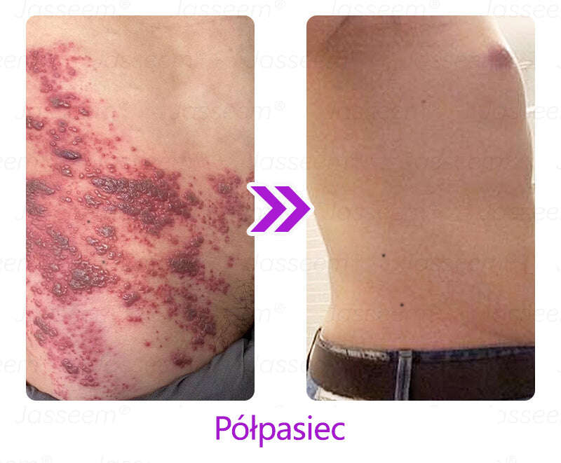 𝐉𝐚𝐬𝐬𝐞𝐞𝐦® Усъвършенстван неинвазивен CO₂ лазер за възстановяване на кожата 🎉 (Нежно премахва брадавици, бенки, старчески петна и кожни образувания – без болка, без суетене!)