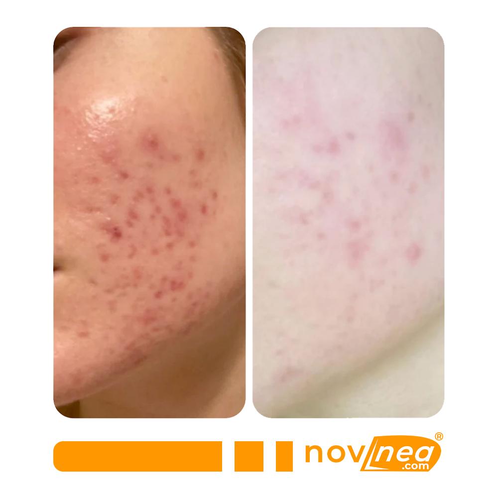 Creme anti-verrugas e verrugas com veneno de abelha