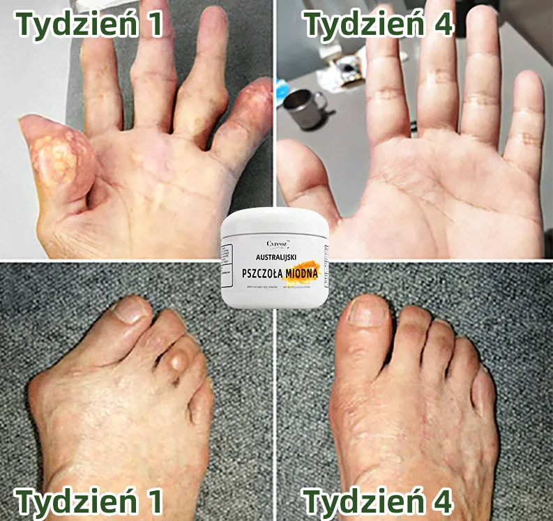 🚩🚩Australian Honey Bee Truison Cvreoz™ krém fájdalomcsillapításra és csontgyógyításra (🐝 Korlátozott idejű kedvezmény az utolsó 30 percre 💥）